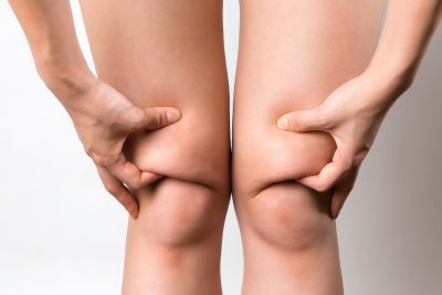 膝の上の脂肪をつまむ女性