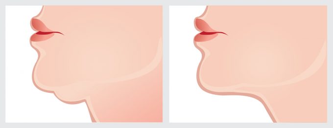 二重あご脂肪吸引手術の症例　イラスト