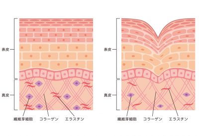 しわ　皮膚の構造　断面図
